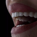 Veneers: A Versatile Solution For A Perfect Smile